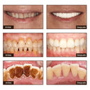 Blanqué™ – Blanqueamiento potente, sonrisa impecable