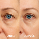 LidLift - Mirada Joven, Sin Cirugía