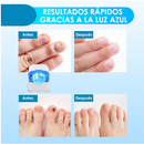 Uñas Perfectas™ LASER UÑAS DEL PIE Y MANOS - EL MEJOR TRATAMIENTO PARA TUS UÑAS